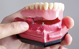 Model of imjplant supported denture