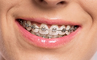 Closeup of smile with braces