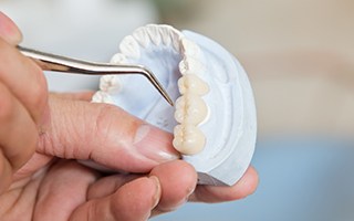 Model smile with fixed bridge restoration