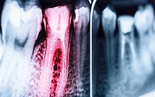 Dental x-ray with tooth highlighted red