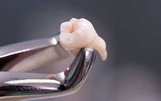 Metal clasp holding extracted tooth