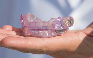 Hand holding an occlusal splint